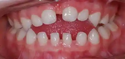 Co bych měla předem vědět o dudlíku?