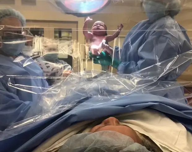 Jak se připravit na plánovaný císařský řez